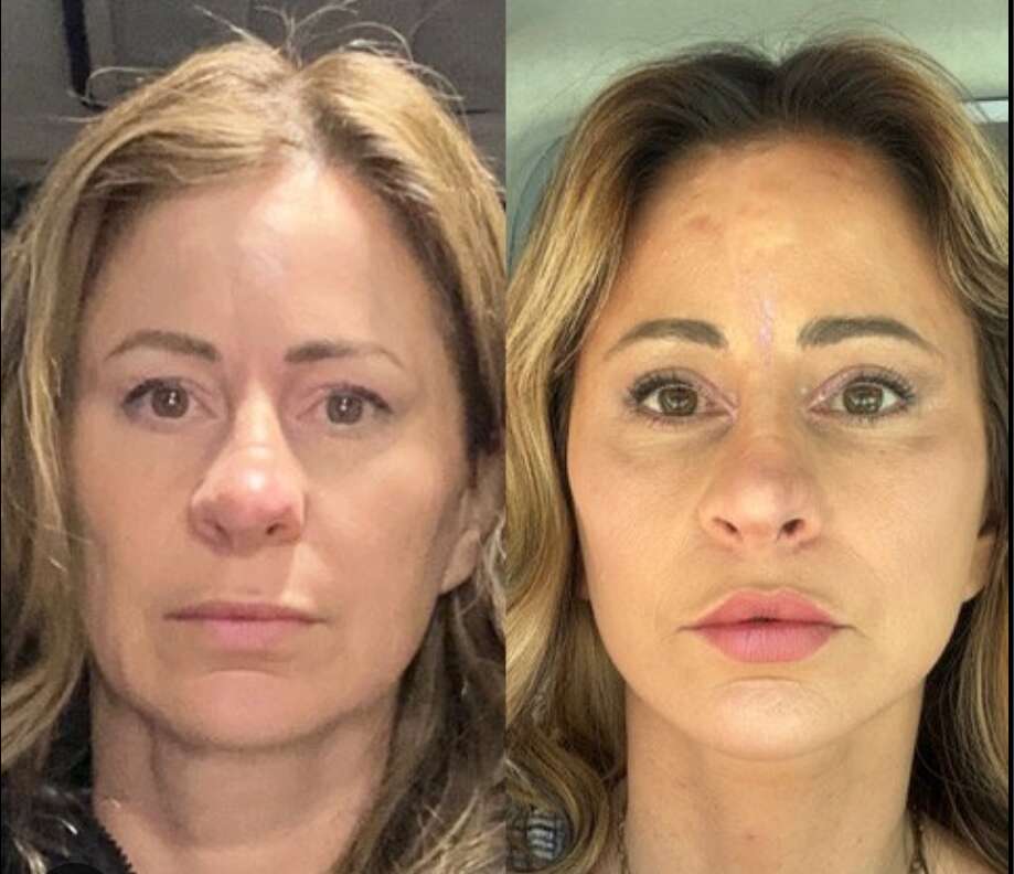 Woman Sells House for Facelift Surgery and Never Looked Back