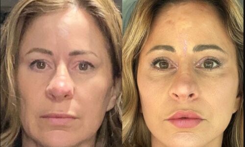 Woman Sells House for Facelift Surgery and Never Looked Back