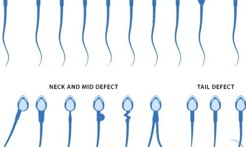 Global Semen Analysis Market – Global Industry Insights, Trends, Analysis and Forecast 2018-2025 - Market Journal
